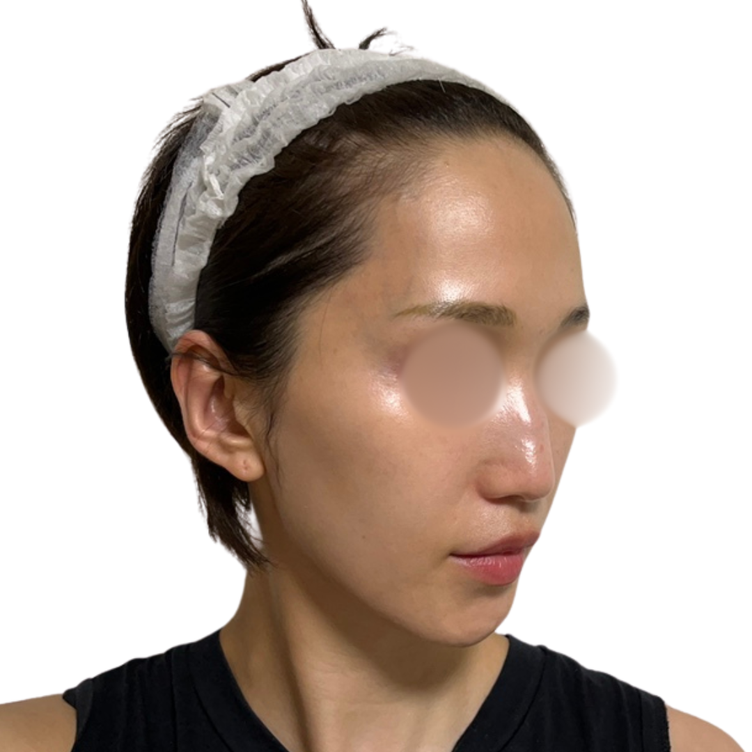 ピコフォーカス（ピコトーニング＋ピコフラクショナル）